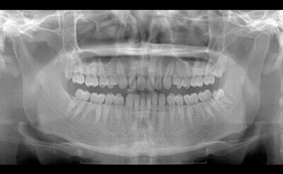 歯科領域撮影2